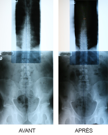 Radiographie lombaire et thoracique