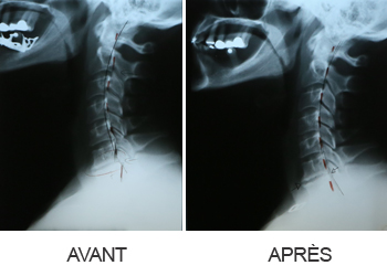 Radiographie colonne cervicale